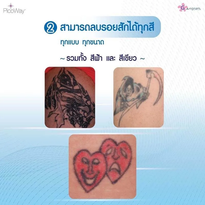 ลบรอยสักได้ทุกสี