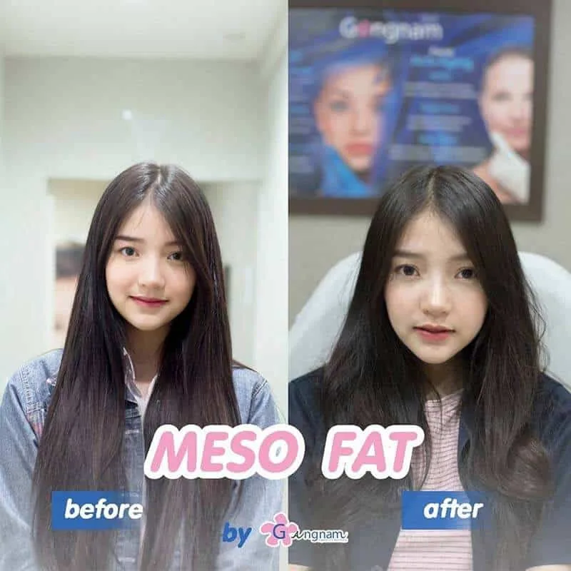 รีวิวหลังฉีดเมโสแฟต Before After