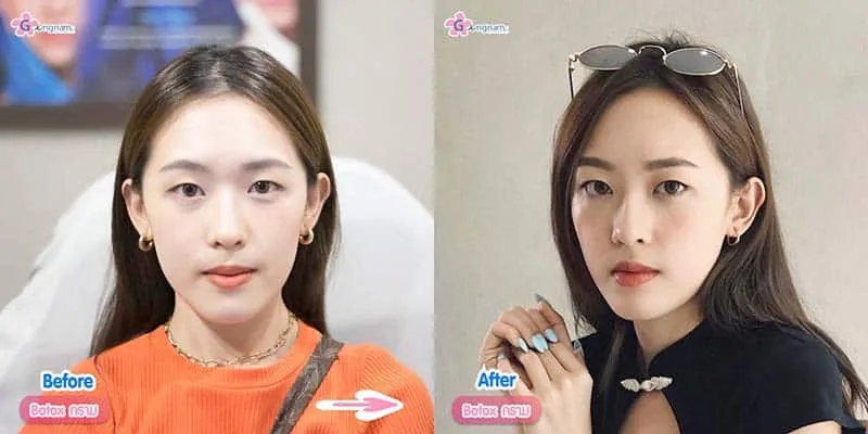 รีวิวโบท็อกลดกราม