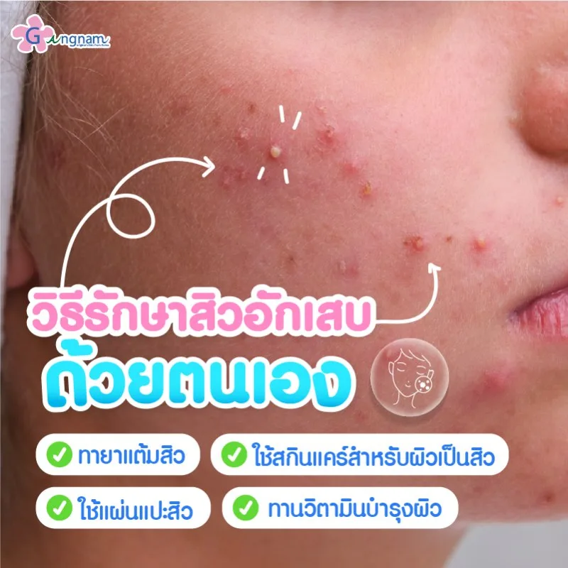 รักษาสิวอักเสบ ด้วยตนเอง