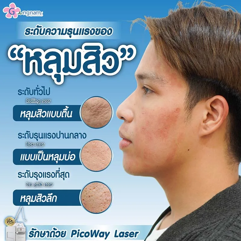 ระดับความรุนแรงของหลุมสิวแต่ละประเภท