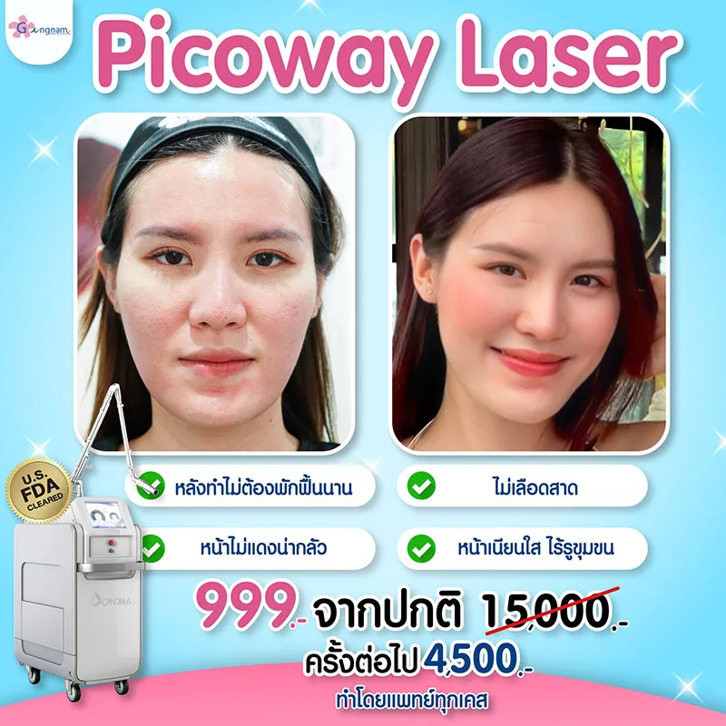 โปรโมชั่นเลเซอร์หลุมสิวครั้งแรก