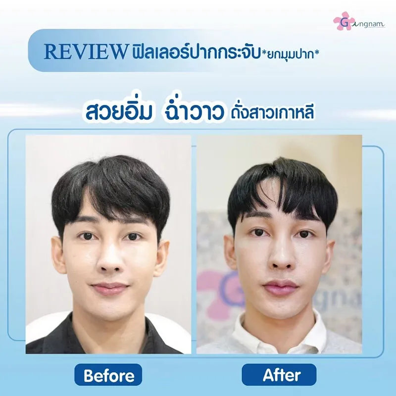 การฉีดฟิลเลอร์ปาก ยกมุมปาก