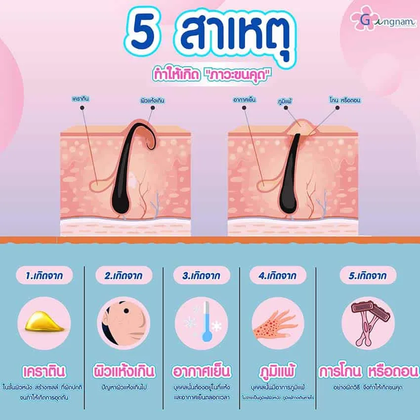 สาเหตุการเกิดขนคุด