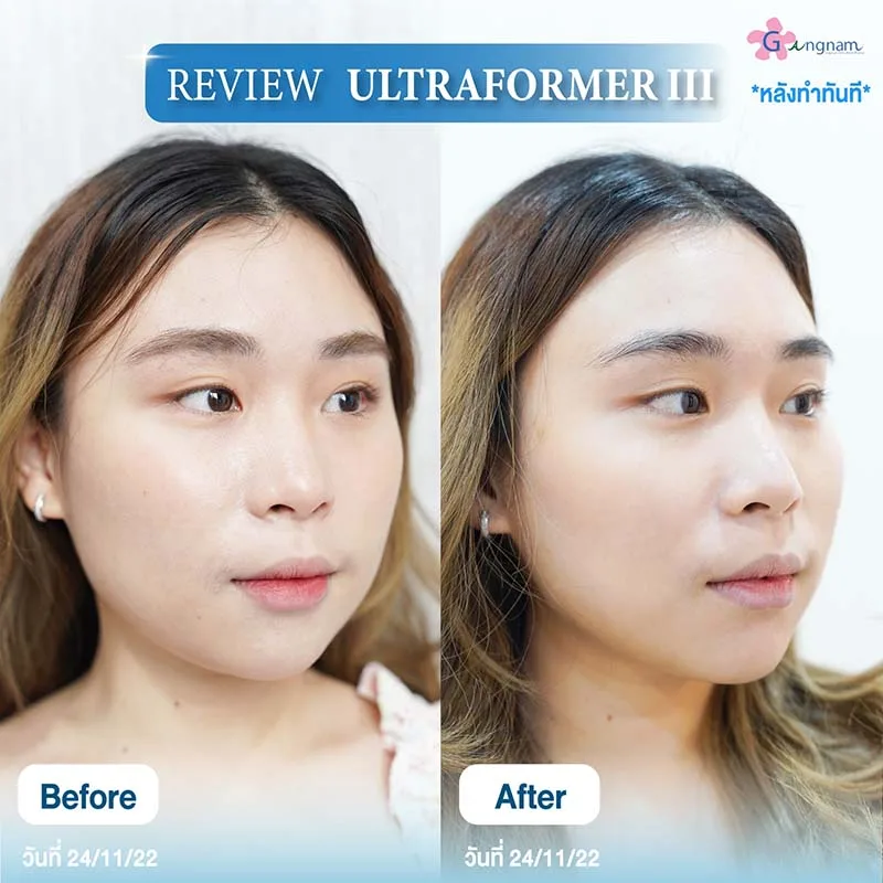 รีวิวหลังทำ Ultraformer III