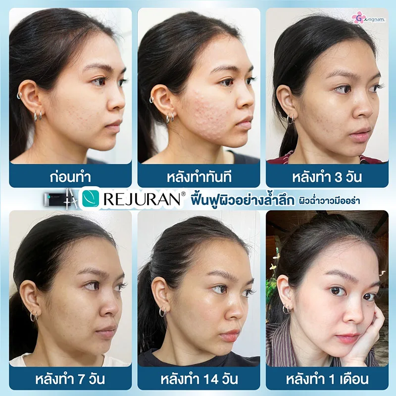 รีวิวลำดับการเปลี่ยนแปลงหลังฉีดรีจูรัน