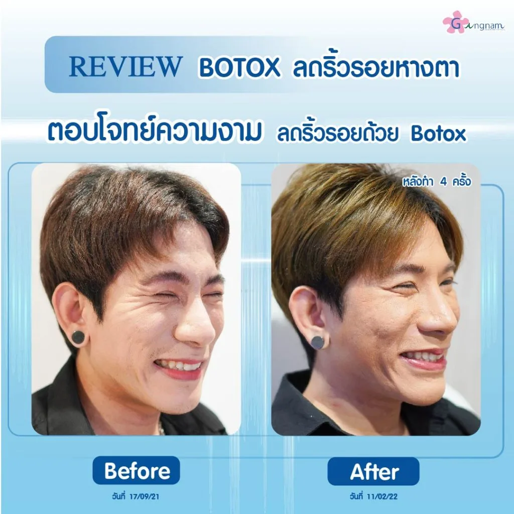 ฉีดโบท็อกลดริ้วรอยหางตา