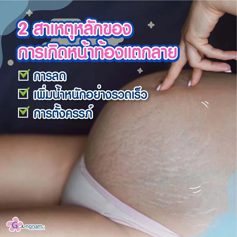 หน้าท้องแตกลายหลังคลอด-เกิดจาก