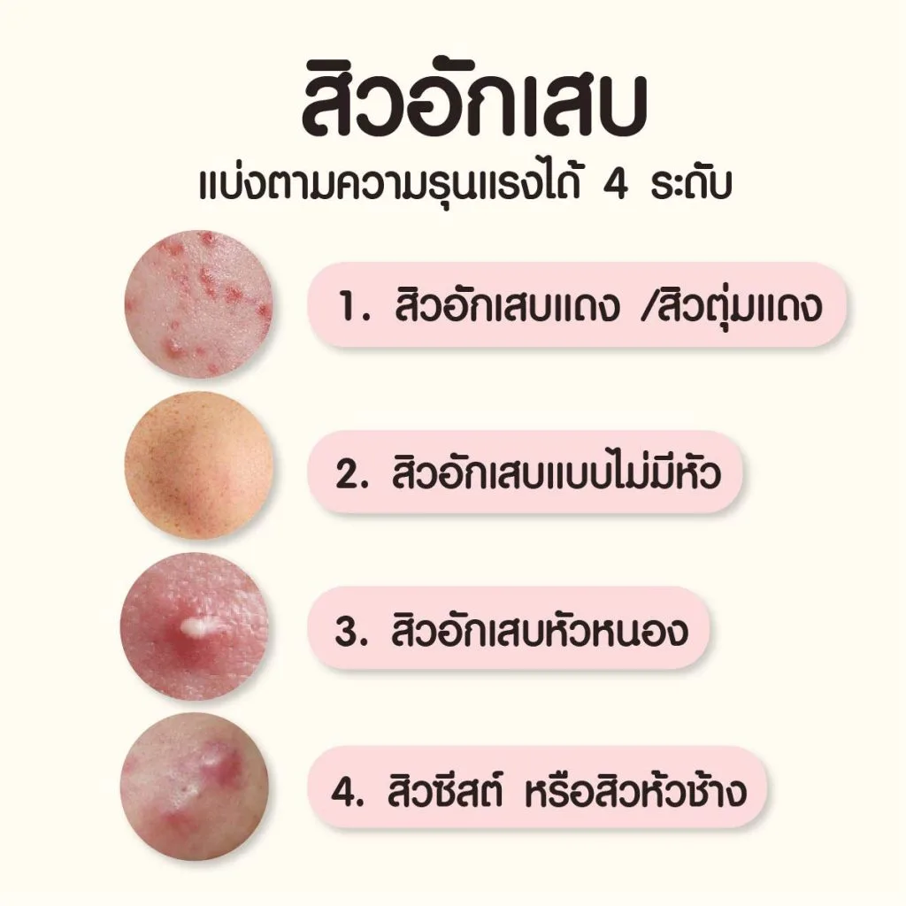 สิวอักเสบ มีกี่แบบ