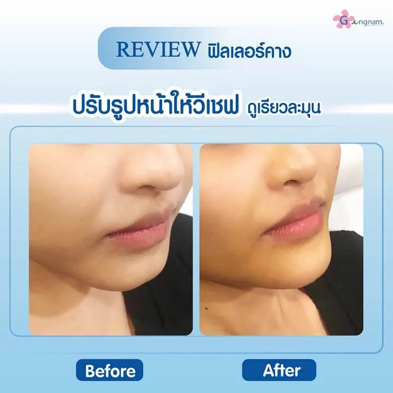 ฉีดฟิลเลอร์คาง ปรับรูปหน้าวีเชฟ