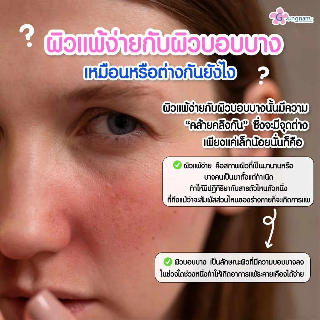 ผิวแพ้ง่ายกับผิวบอบบาง ต่างกันยังไง
