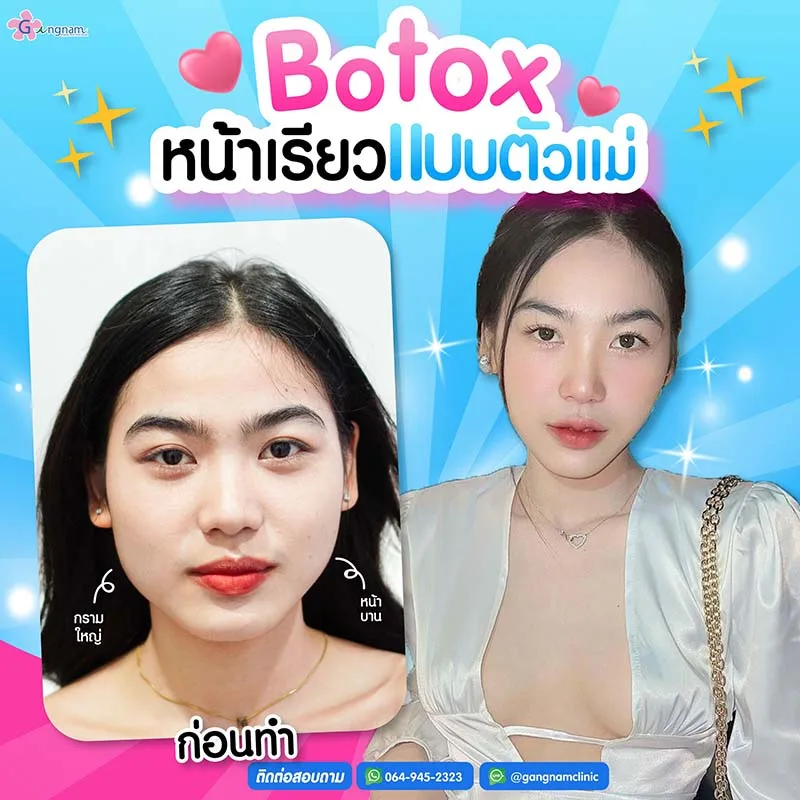 การฉีดโบท็อกกราม ให้หน้าเรียวขึ้น