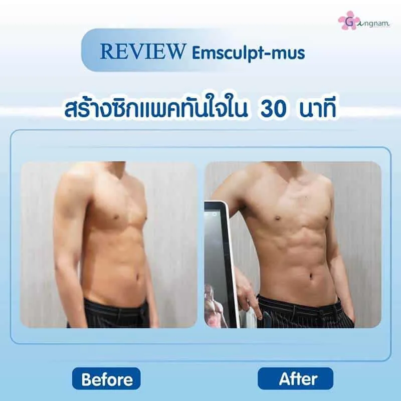 รีวิว Emsculpt-mus สร้างซิกแพคผู้ชาย