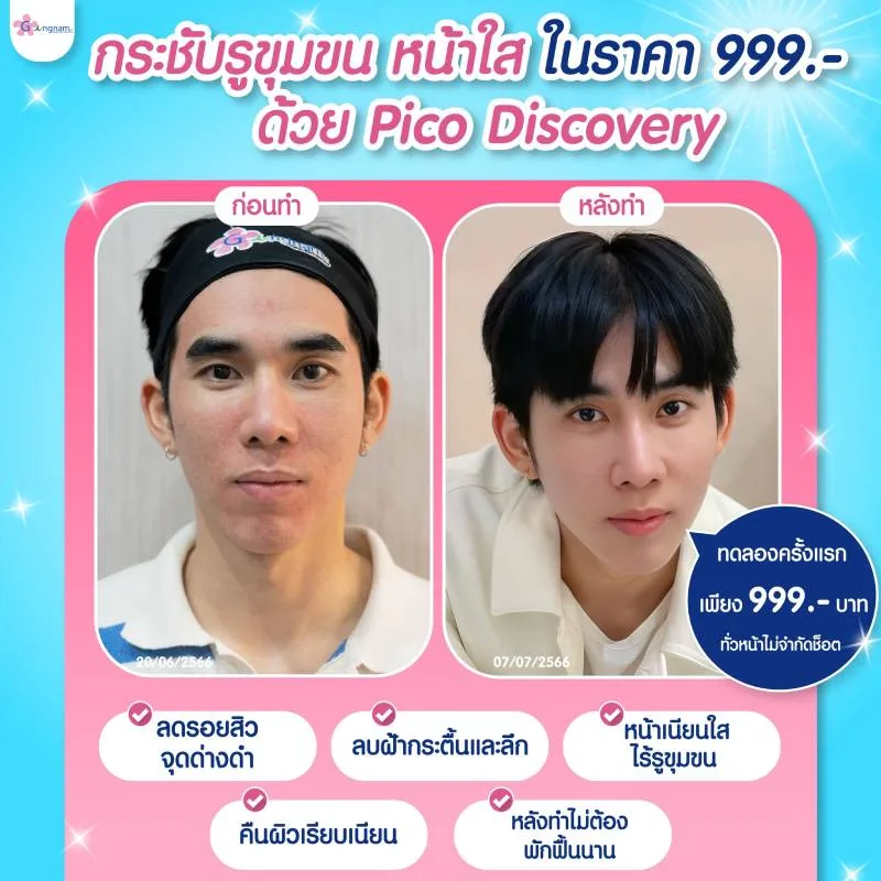ราคาโปรโมชั่นสำหรับทำ Pico Laser