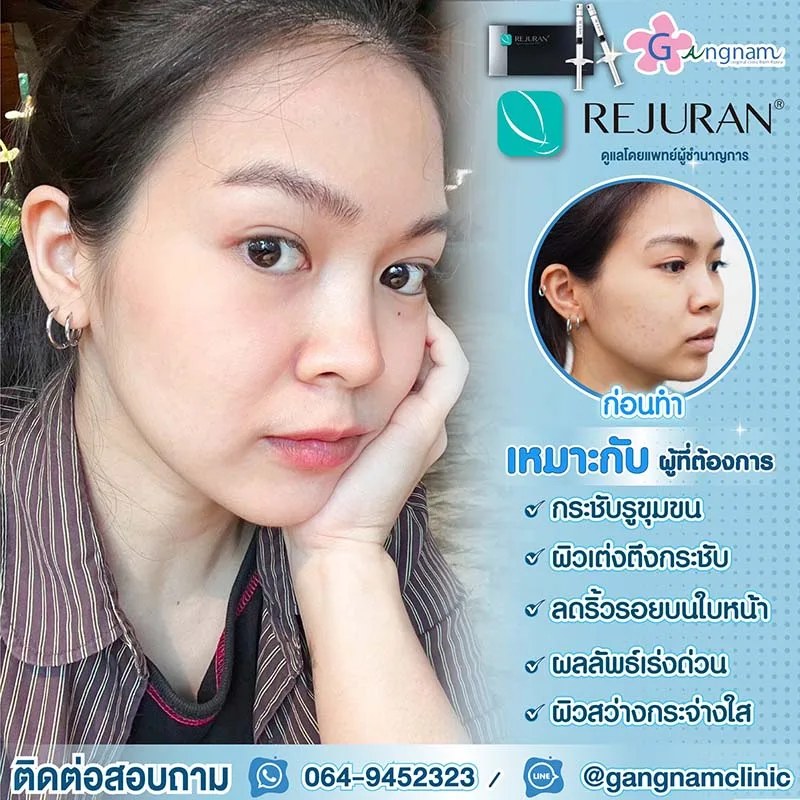 rejuran หน้าใส