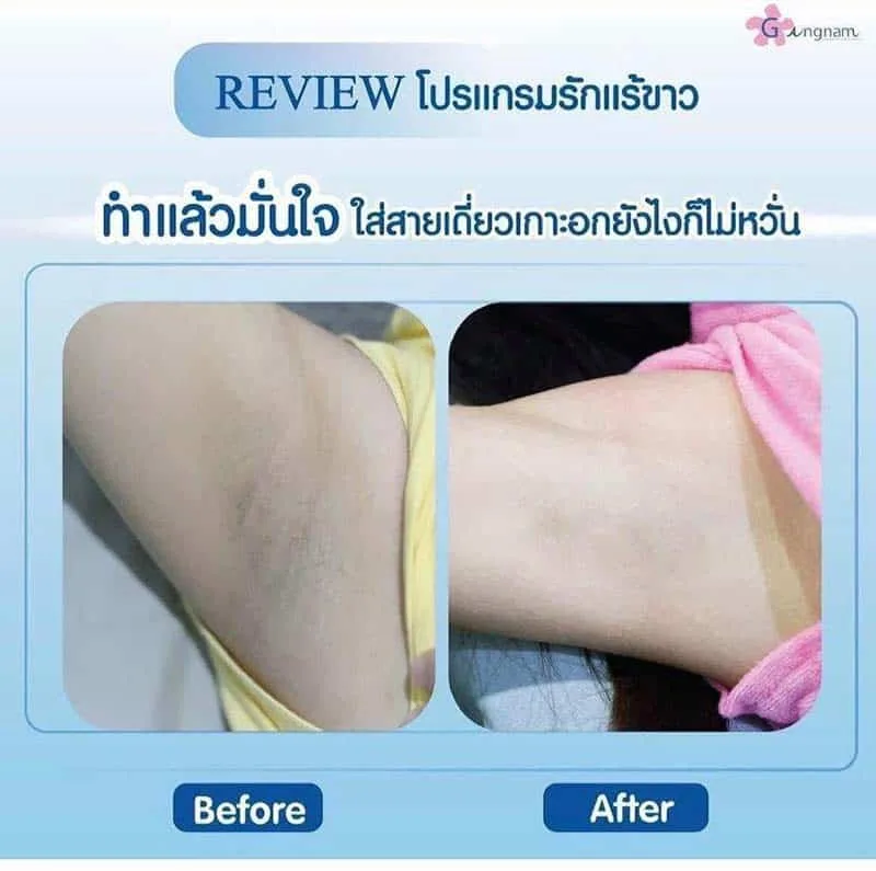 รีวิว-เลเซอร์รักแร้ขาว-ที่กังนัมคลินิก