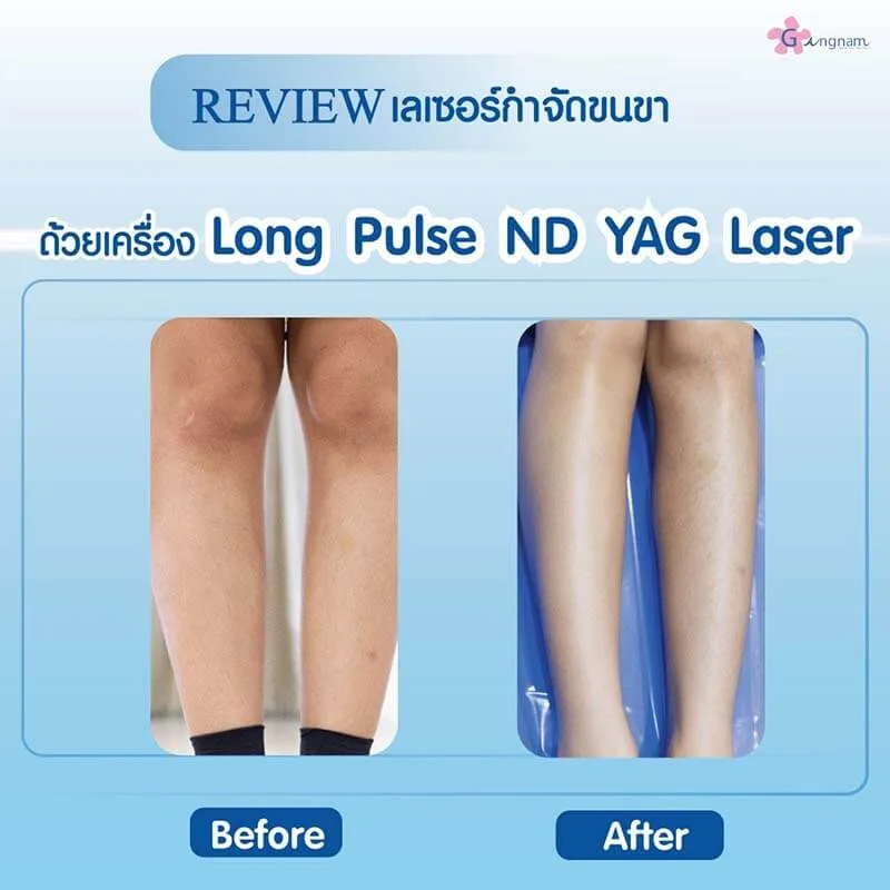 เลเซอร์ขนขาด้วย ND YAG laser