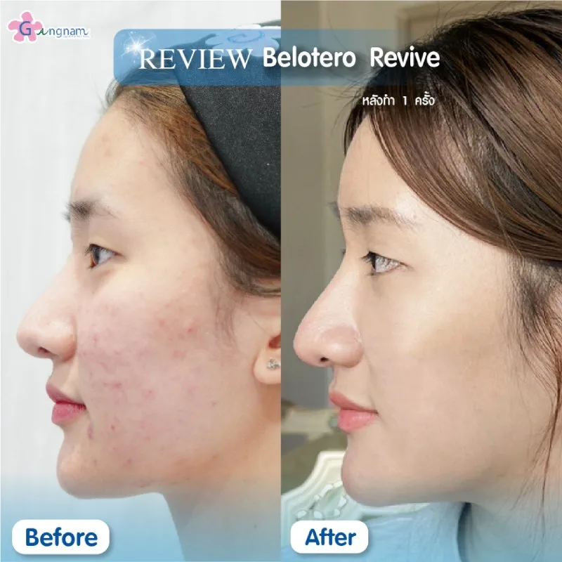 หลังฉีด Belotero Revive กระชับผิว