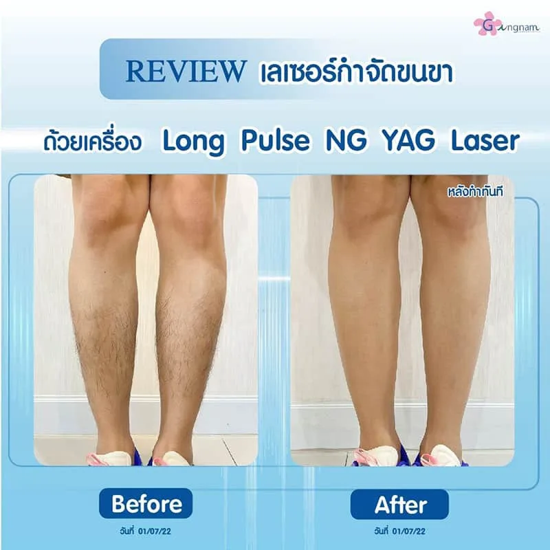 เลเซอร์ขนขา รีวิวหลังทำ