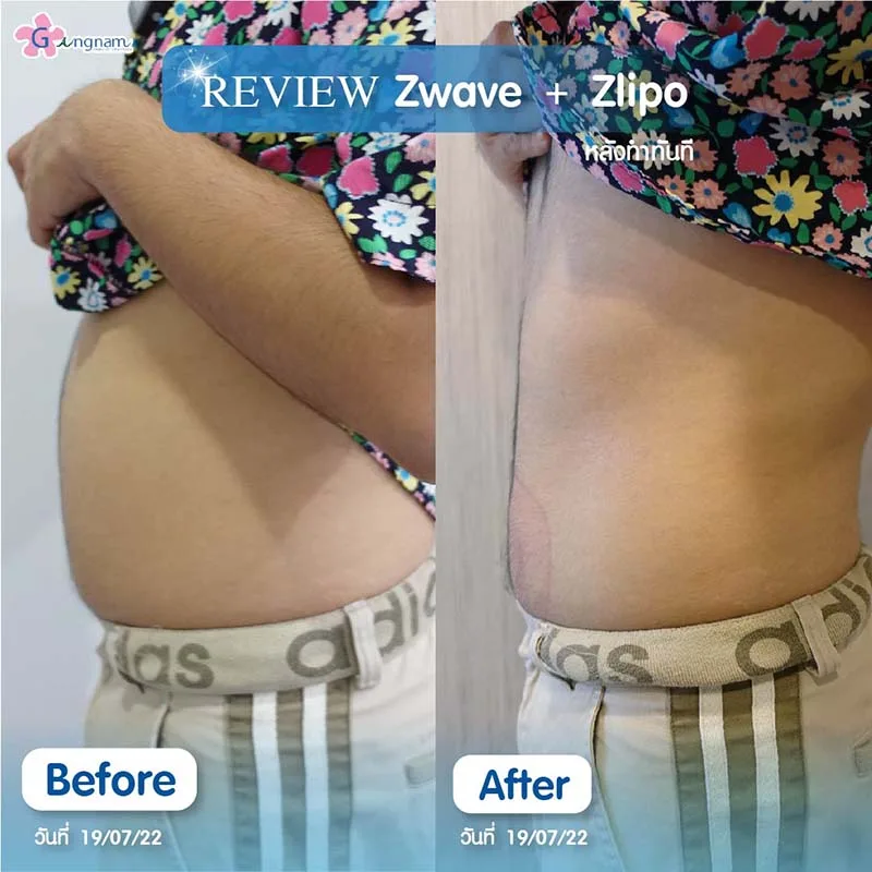 zwavezlipo-ลดไขมันส่วนเกิน