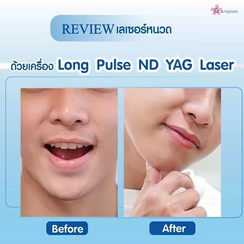 รีวิวเลเซอร์ขน กังนัม 11