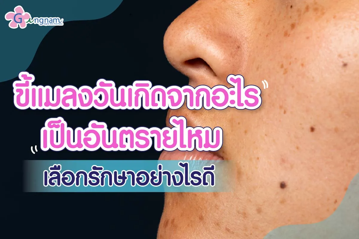ไฝและขี้แมลงวัน บนใบหน้า เกิดจากอะไร? อันตรายไหม มีวิธีกำจัดและรักษาอย่างไร