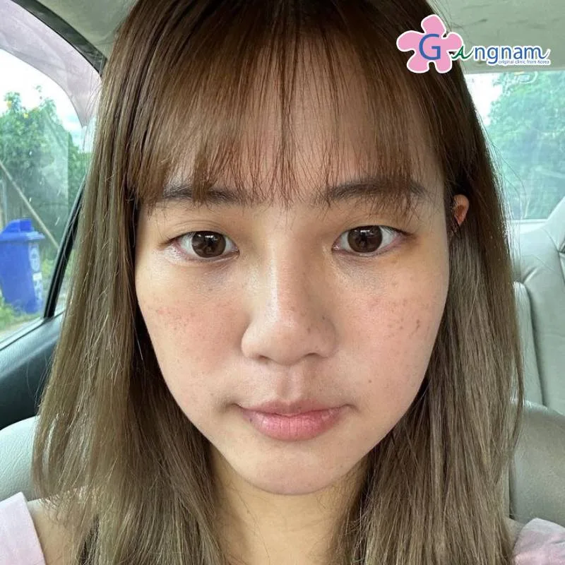คุณแพร หลังทำ 7 วัน