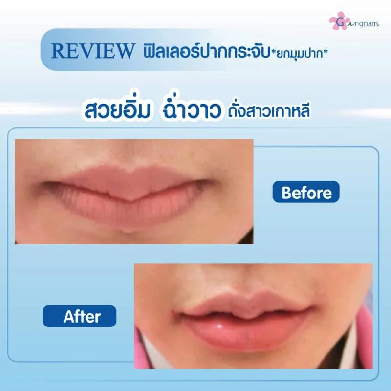 ฉีดฟิลเลอร์ปรับโหงวเฮ้งปาก