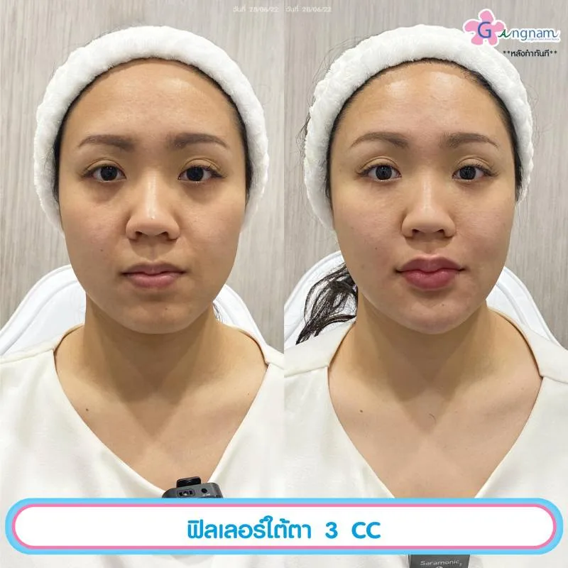 ฉีดฟิลเลอร์ใต้ตา