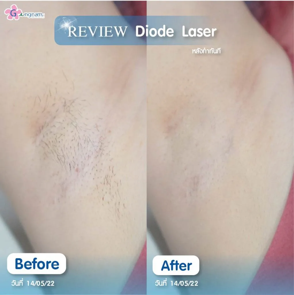 รีวิว Diode Laser กำจัดขนรักแร้