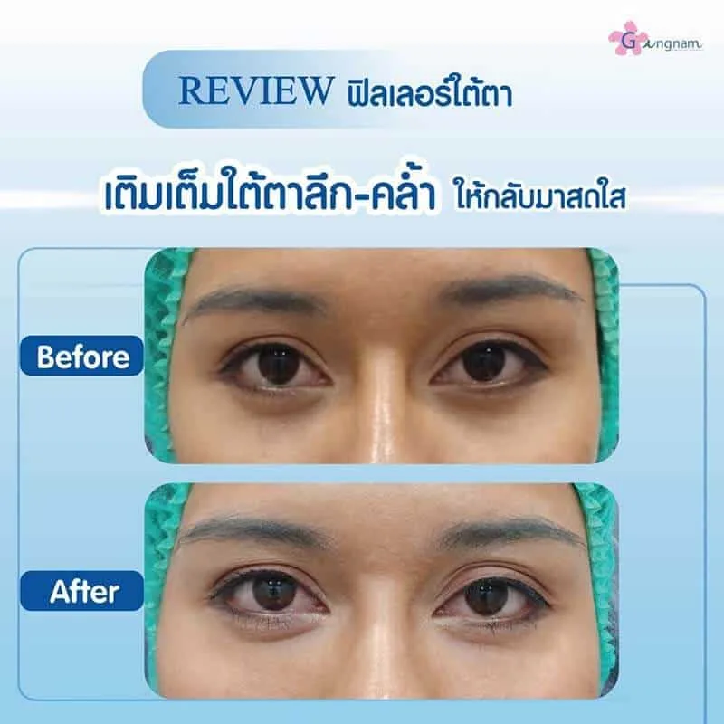 ฉีดฟิลเลอร์ใต้ตา ลดปัญหาใต้ตาลึกและคล้ำ ให้ดูสดใส ไม่น่ากลัวอย่างที่คิด