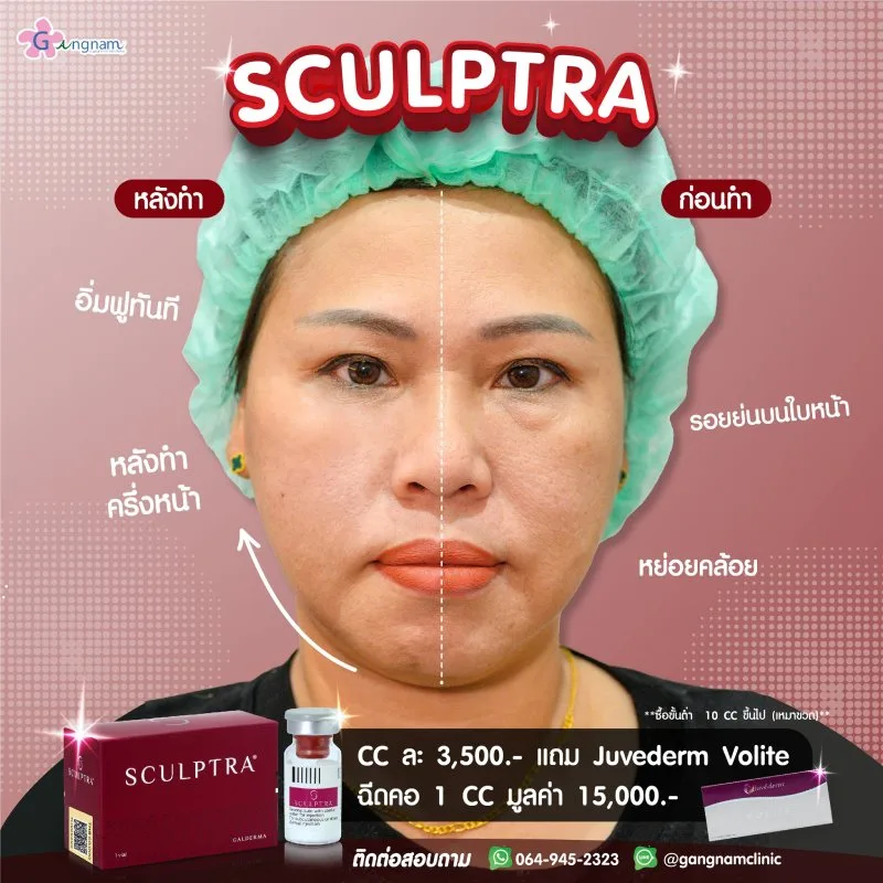 Sculptra รีวิว