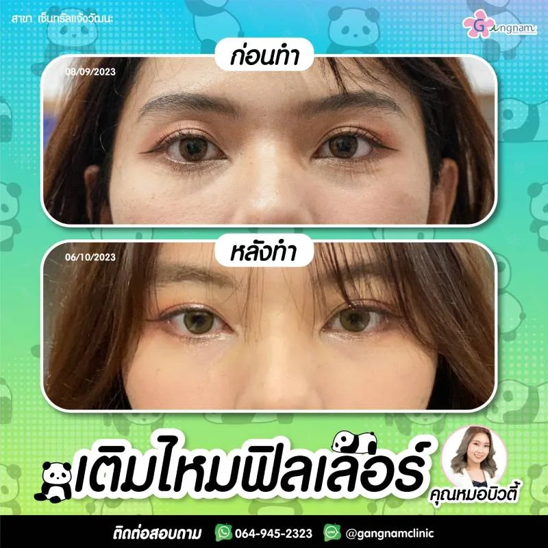 ร้อยไหมยกกระชับถุงใต้ตา