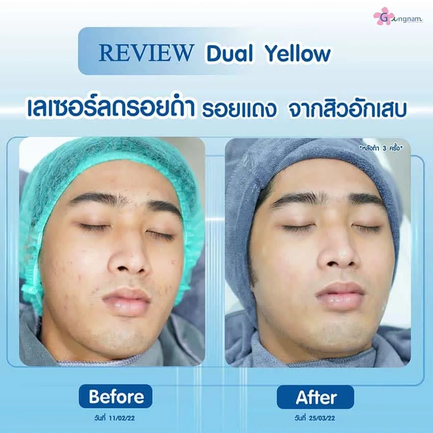 dual yellow เลเซอร์หน้าใส
