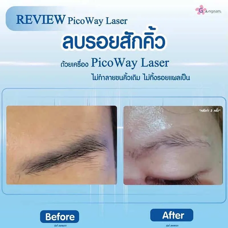รีวิวลบรอยสักคิ้ว picoway
