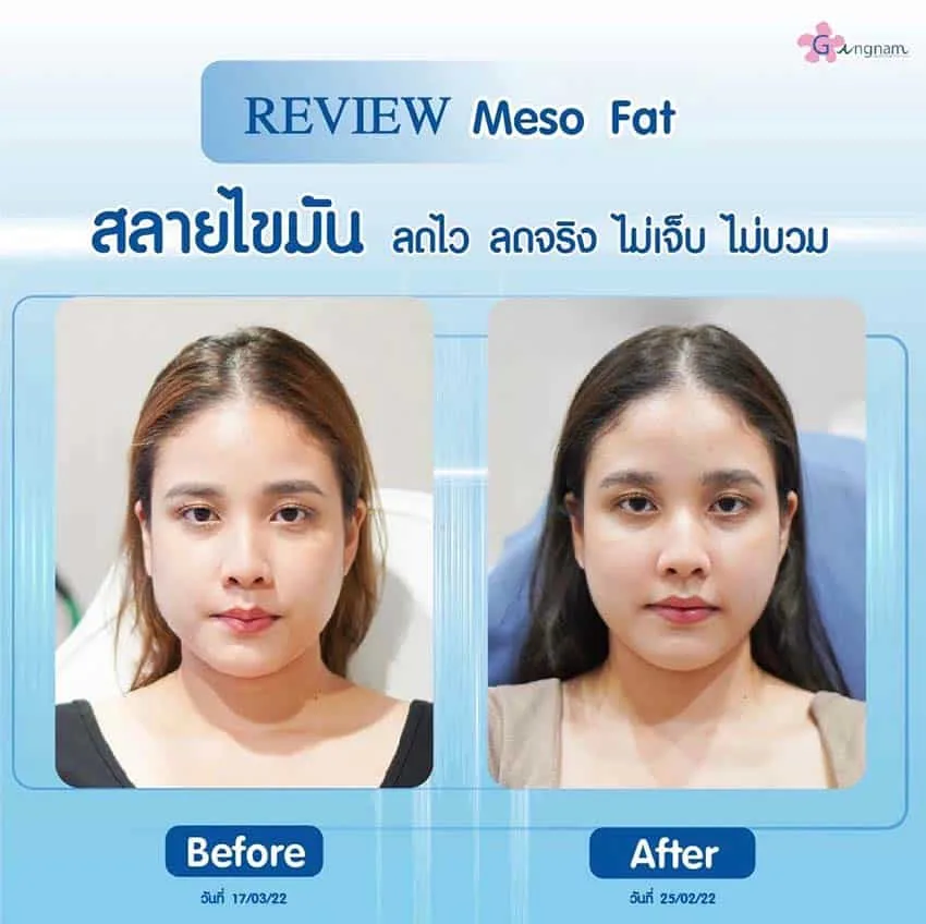 หลัง meso fat สลายไขมันหน้า