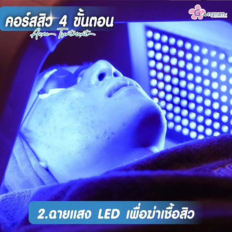 ฉายแสง รักษาสิวหน้าผาก