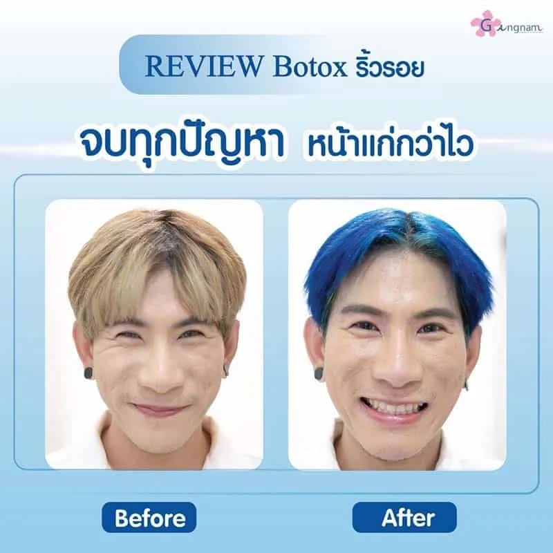 รีวิวโบท็อกริ้วรอยหางตา