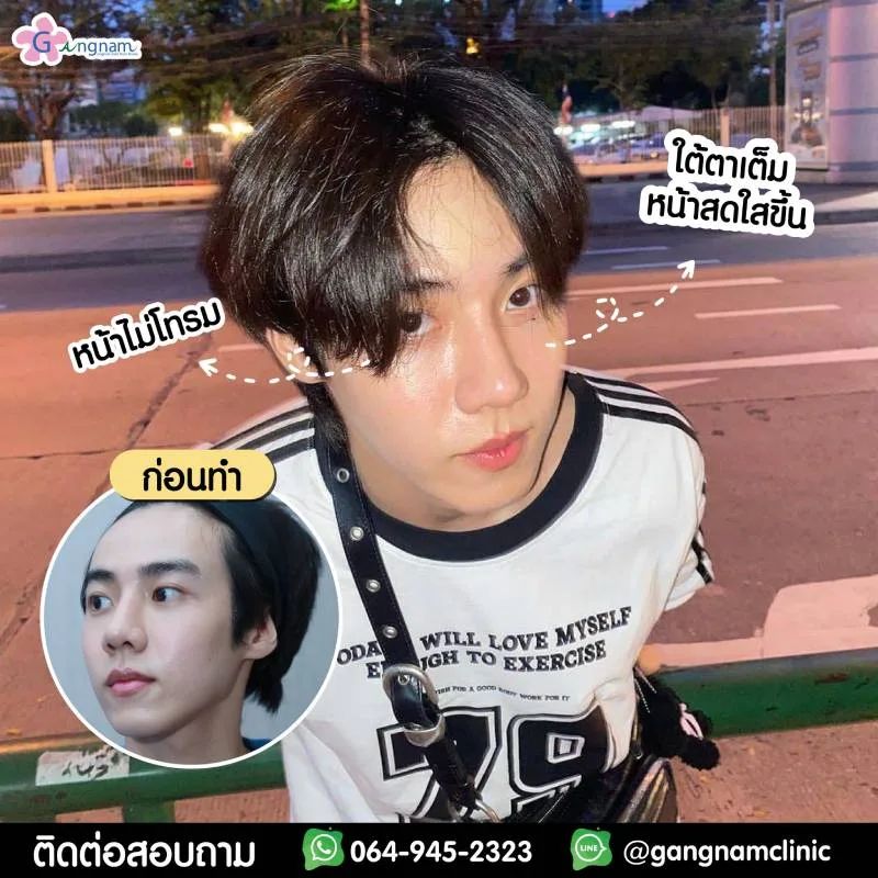 PANDA EYE ก่อนทำ