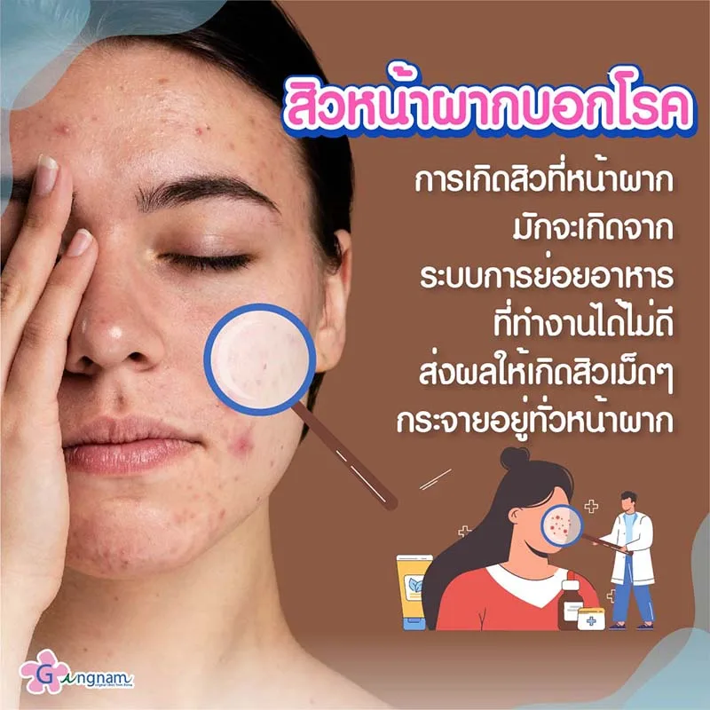 สิวที่หน้าผาก บอกอะไรเรา