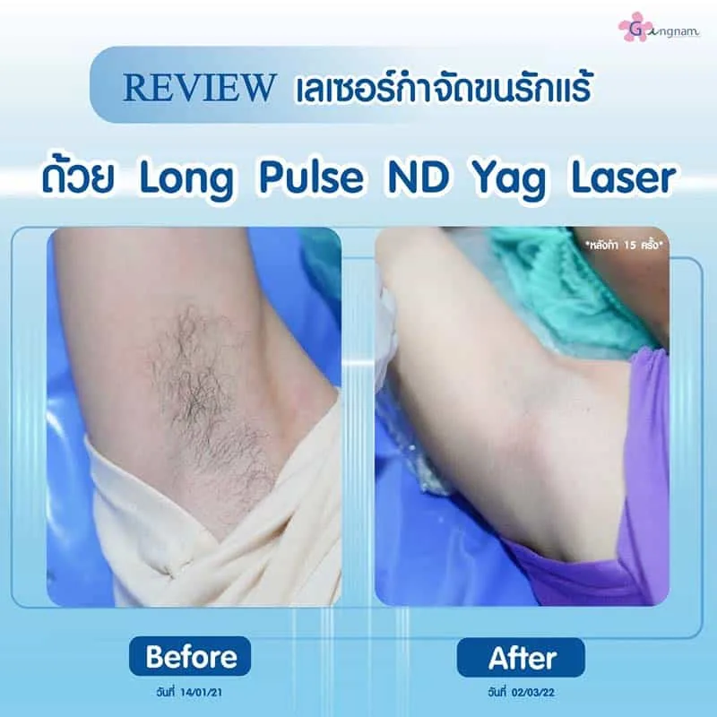 รีวิว เลเซอร์กำจัดขนรักแร้ หลังทำ 15 ครั้ง