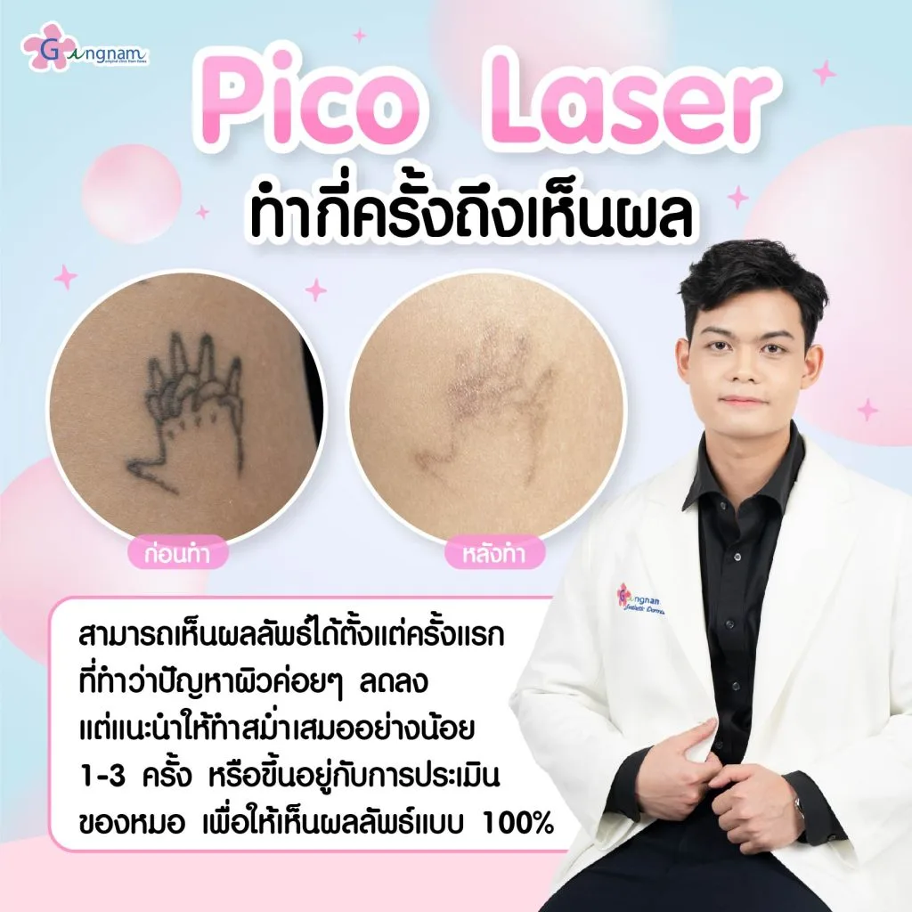 Pico Laser กี่ครั้งถึงเห็นผล