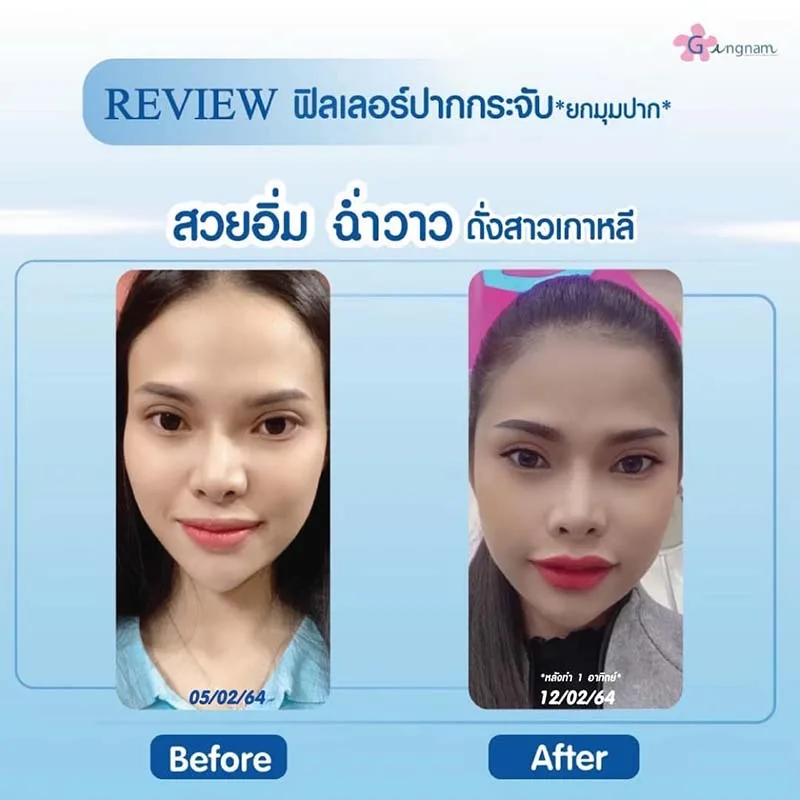 ฉีดฟิลเลอร์ปรับรูปทรงปาก ราคา