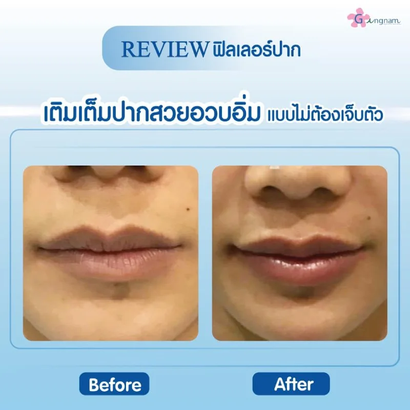 รีวิวฟิลเลอร์ Juvederm