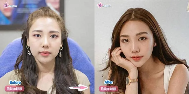 หลังโบท็อกลดกราม