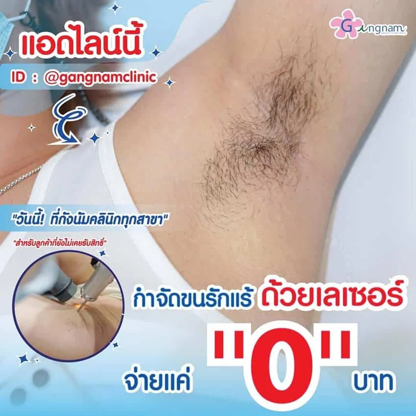 กำจัดขนรักแร้ ด้วยเลเซอร์