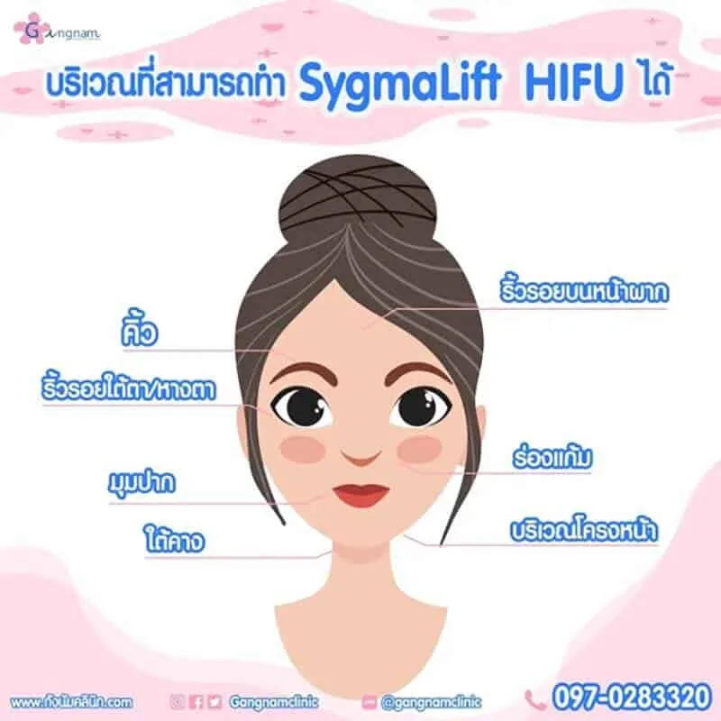 Sygmalift-Hifu-จุดไหนดี
