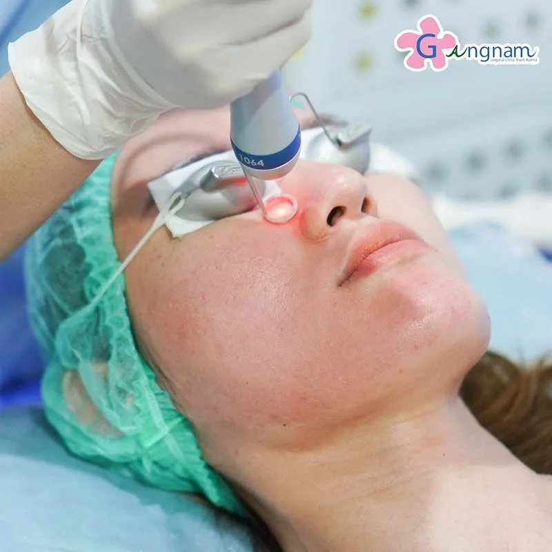 Pico laser รักษารอยดำรอยแดงจากสิว