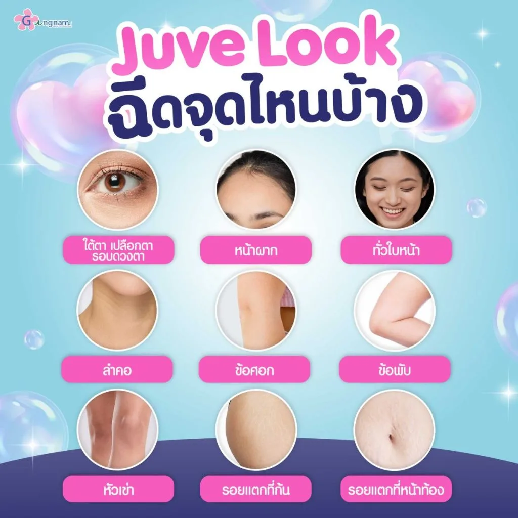 juvelook ใช้ฉีดบริเวณไหนบ้าง