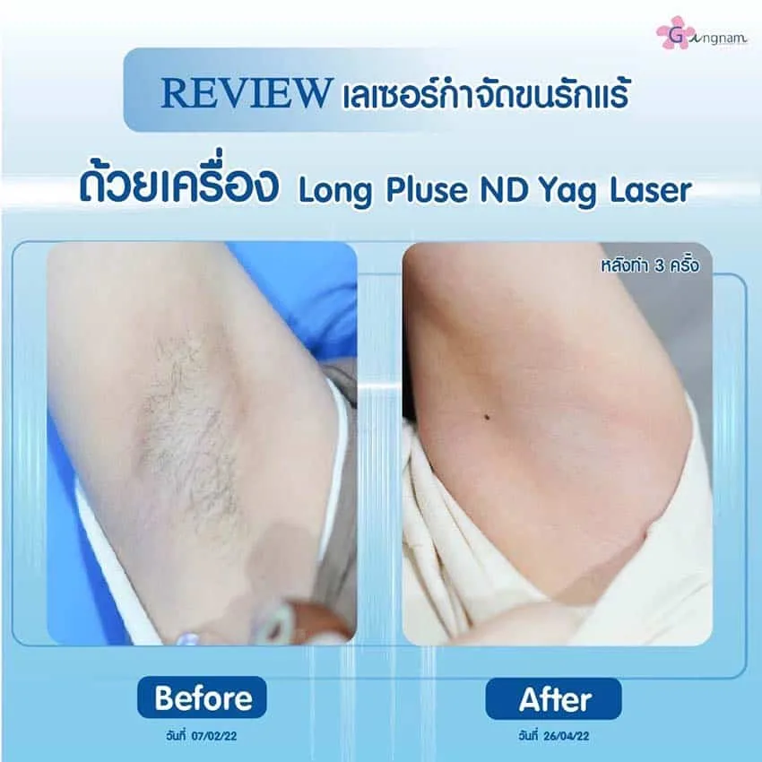 รีวิวเลเซอร์รักแร้-หลังทำ-3-ครั้ง